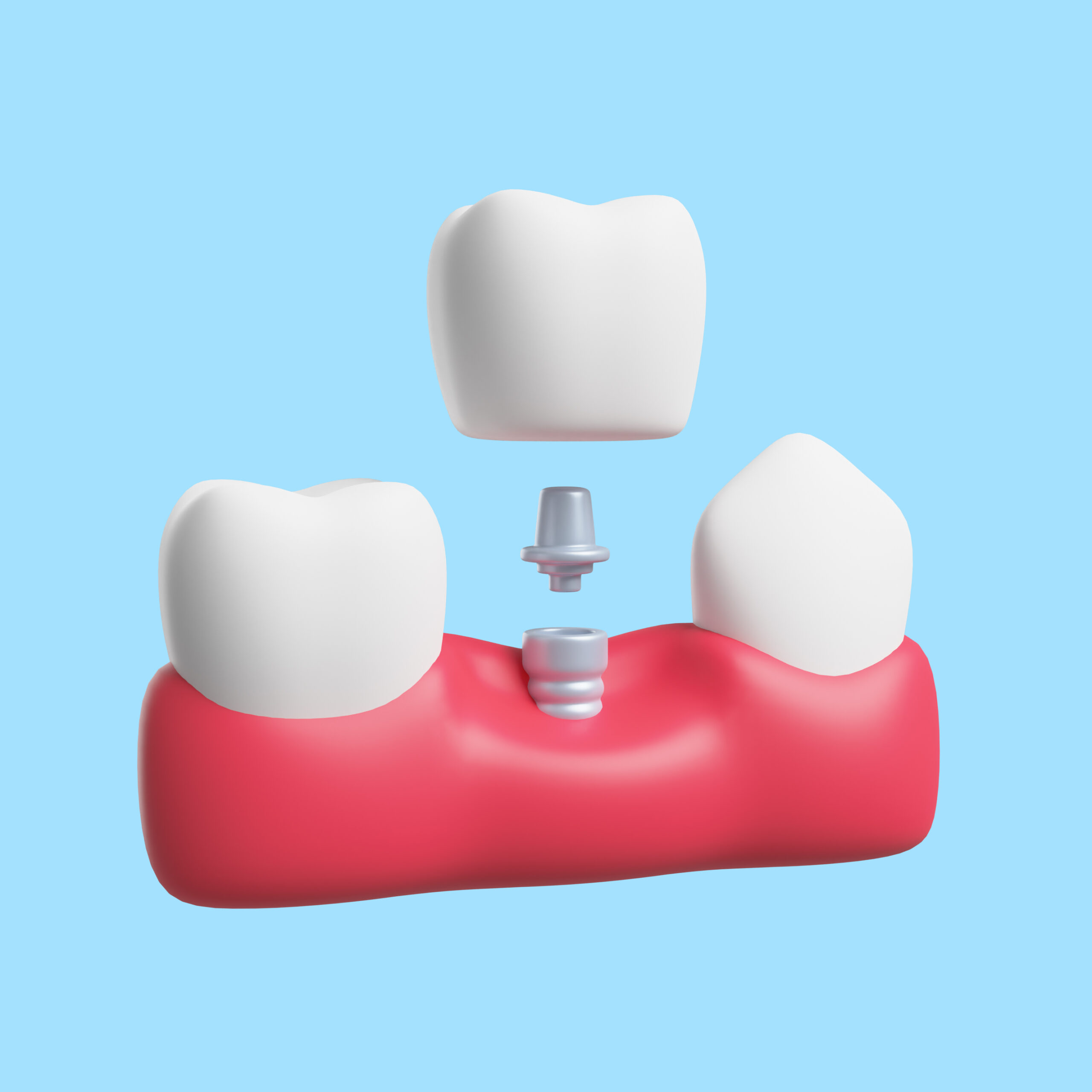 dental bridge